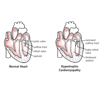 Hypertrophic Cardiomyopathy Overview