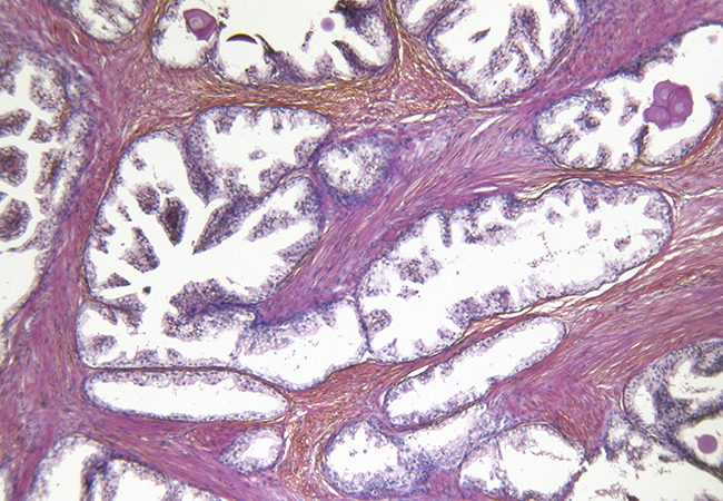 closeup of prostate cancer tissue