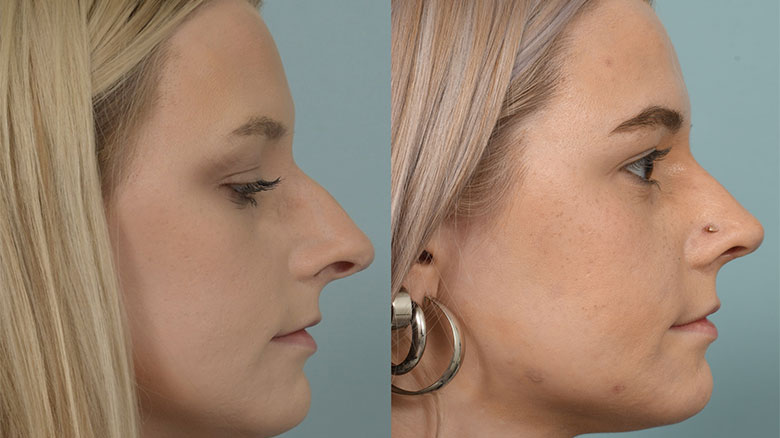 Rhinoplasty before (left) and after (right) at Cleveland Clinic.