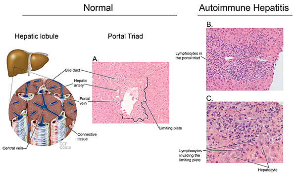 Figure 2: Histologic hallmarks of autoimmune hepatitis.