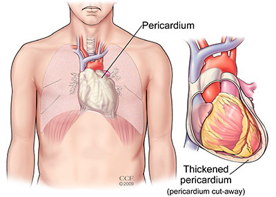 An illustration of the pericardium covering the outside of the heart.