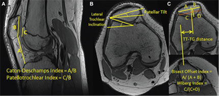 Xray images of measurements used to characterize knee anatomy and patellofemoral alignment.