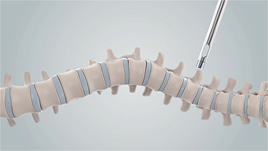 Tethering allows for a patient with scoliosis to have more flexibility.