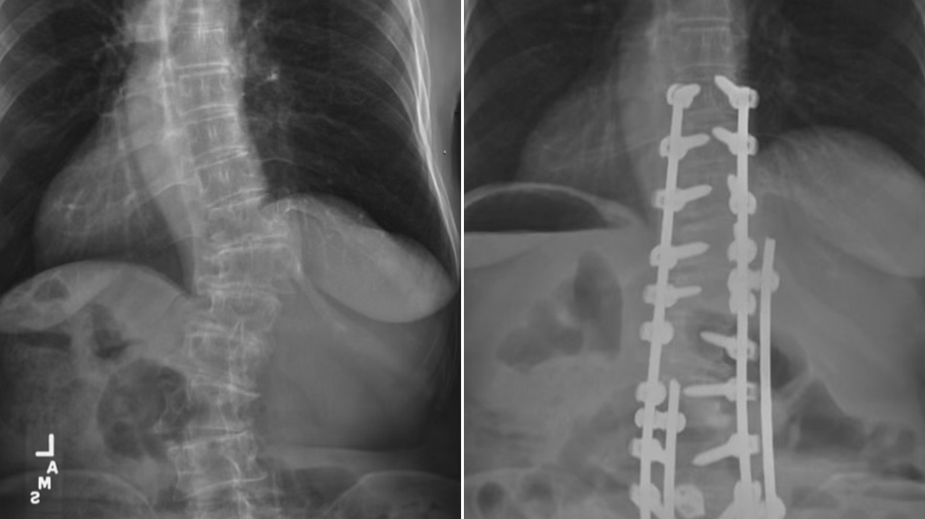 Monica's spine before and after surgery.