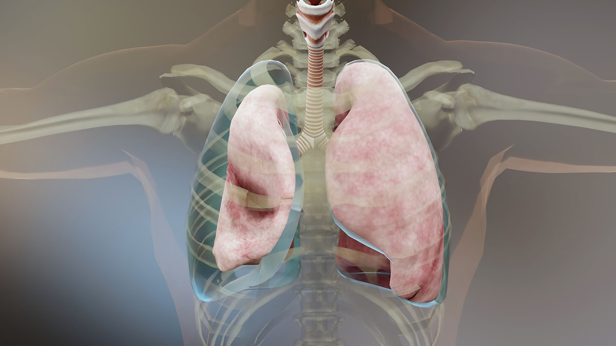 Pneumothorac Pic