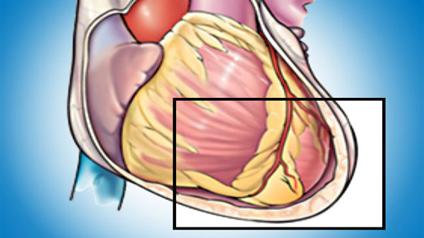 Pericarditis