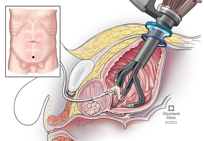 robotic prostatectomy diagram